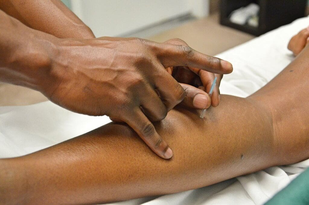 A picture of a patient receiving acupuncture in the right calf